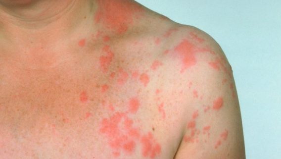 901 Skinmd_Herpes Zoster (Shingles)