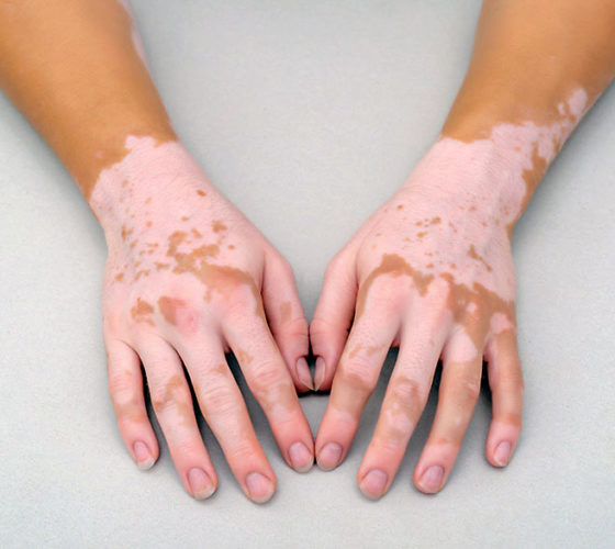 Vitiligo on skin of hands.