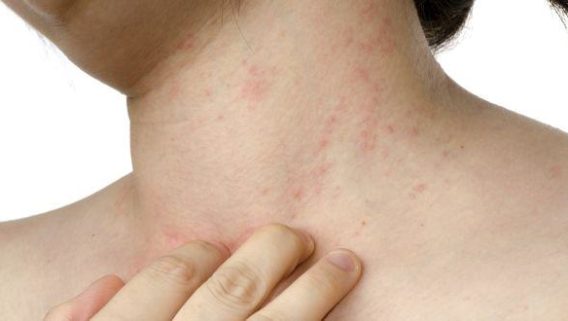 901skinmd_Allergic Contact Rashes