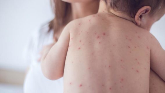 skin deasorder_measles